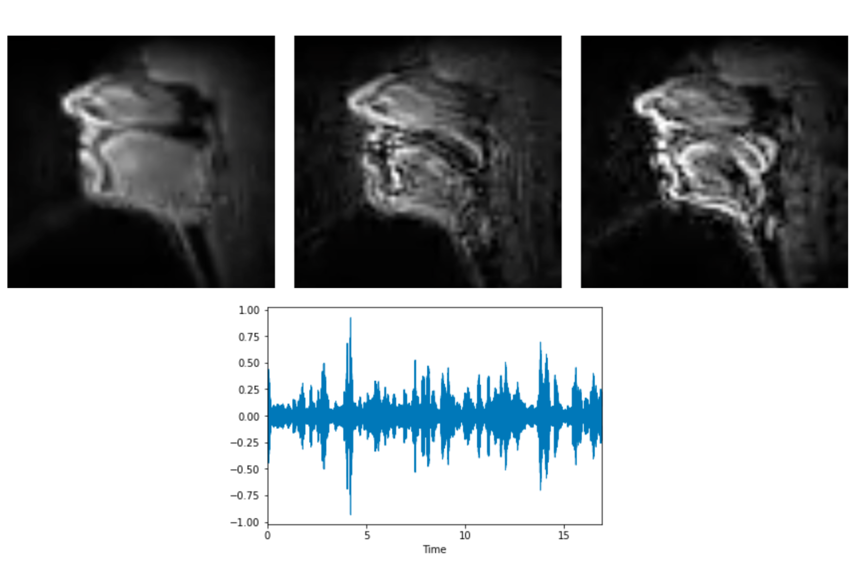 Speech Synthesis From Silent rtMRI Videos